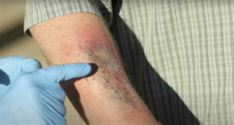 what happens if i touch battery acid|Battery Acid on Skin: How to Treat a Chemical Burn